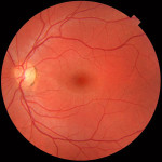canon retina left eye 600x600